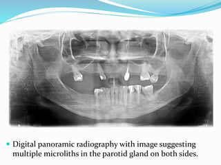 Multiple Microliths Soft tissue calcification of head and neck | PPTX