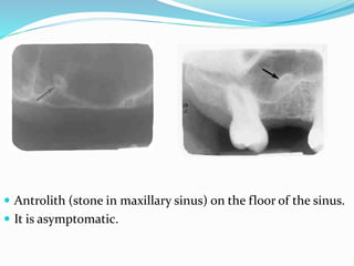 Soft tissue calcification of head and neck | PPTX