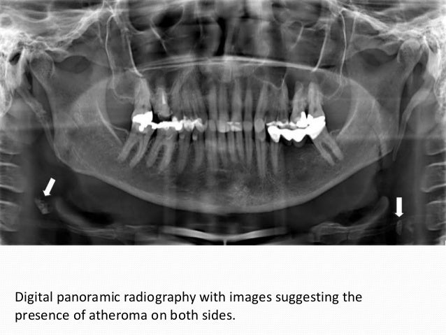 Soft tissue calcification of head and neck