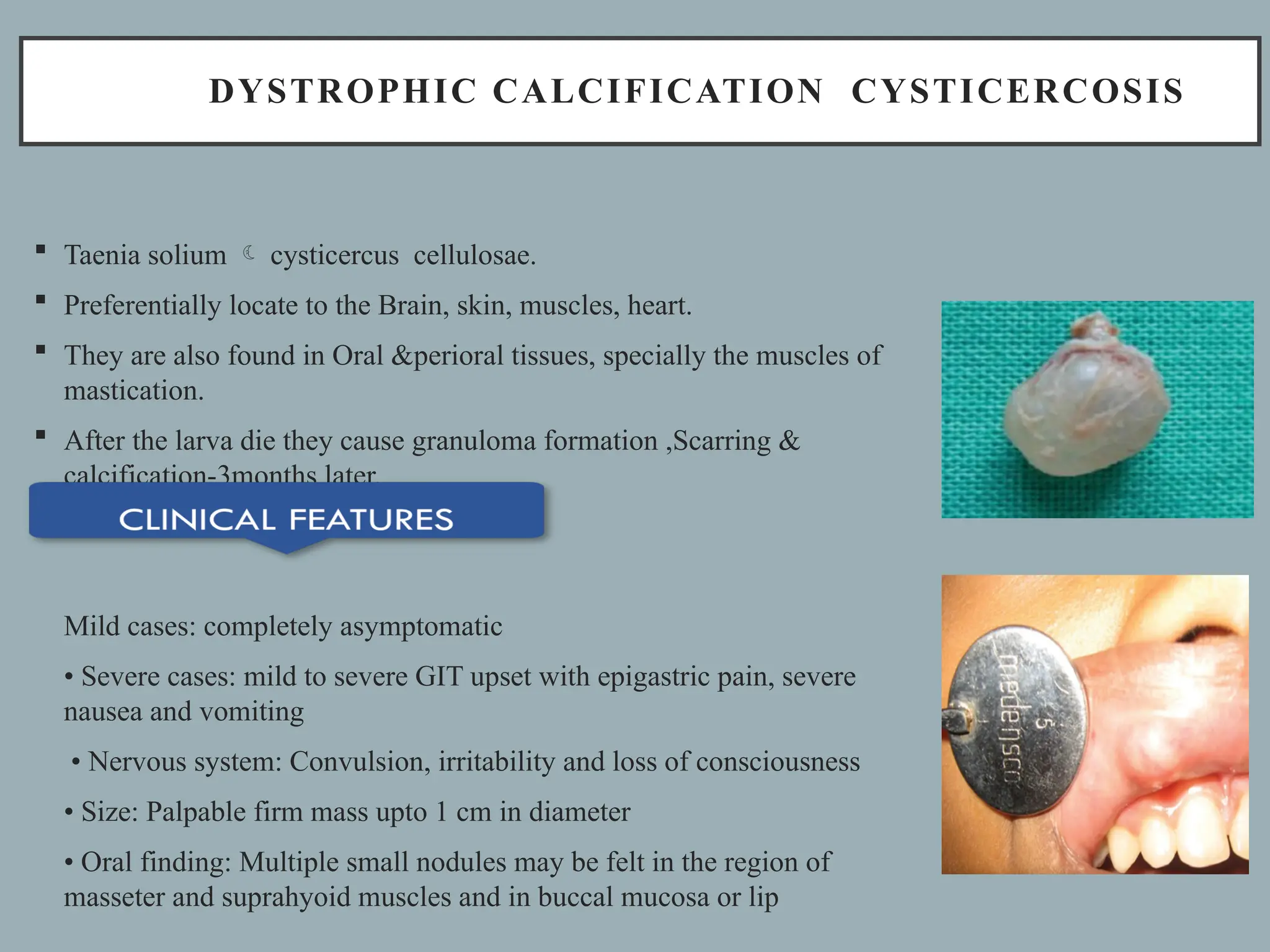 SOFT TISSUE CALCIFICATIONS.pptx ( oral medicine and Radiology) | PPTX