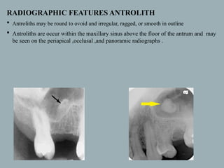 SOFT TISSUE CALCIFICATIONS.pptx ( oral medicine and Radiology) | PPTX