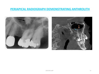 abnormal calcifications in head and neck region also with oral tissues ...