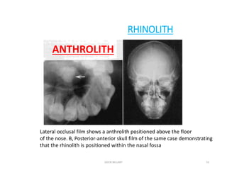 abnormal calcifications in head and neck region also with oral tissues ...