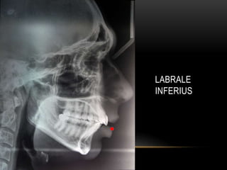 LABRALE
INFERIUS

 