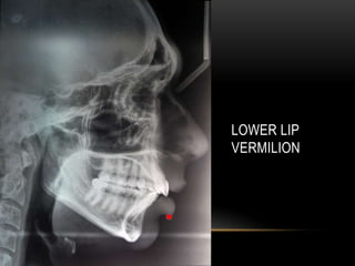 LOWER LIP
VERMILION

 