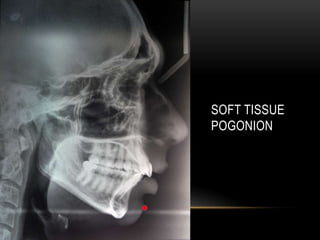SOFT TISSUE
POGONION

 