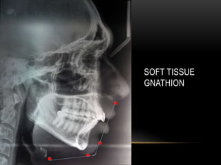 SOFT TISSUE
GNATHION

 