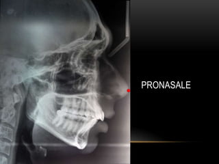 PRONASALE

 