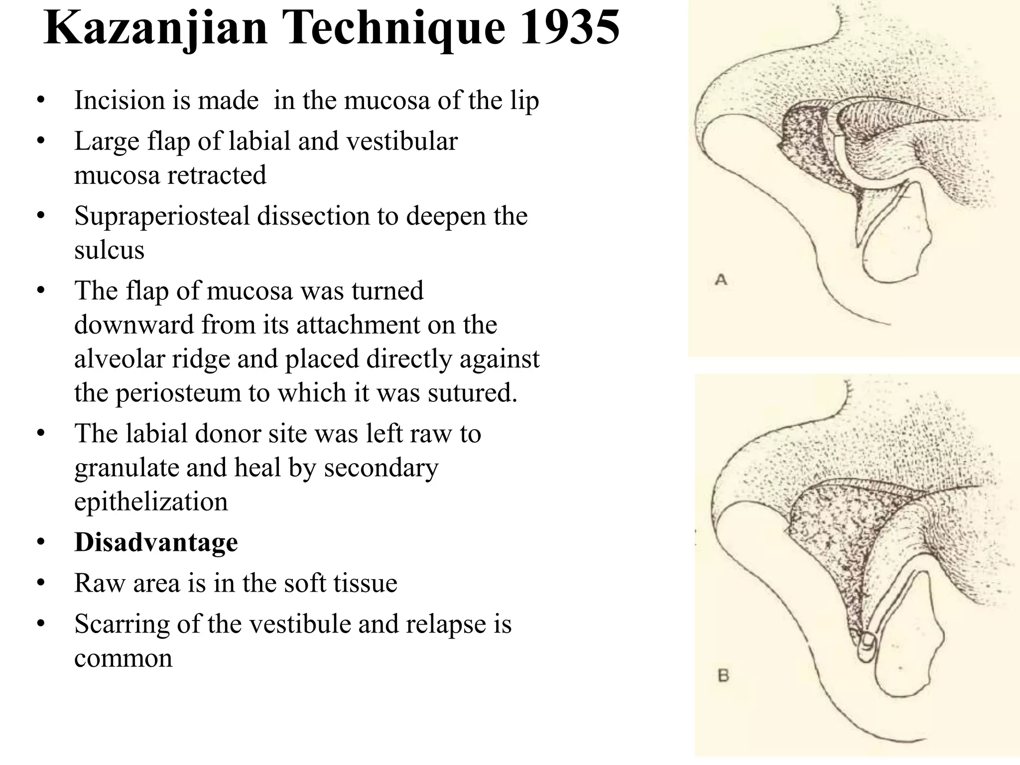 Soft tissue changes in preprosthetic surgery | PPTX