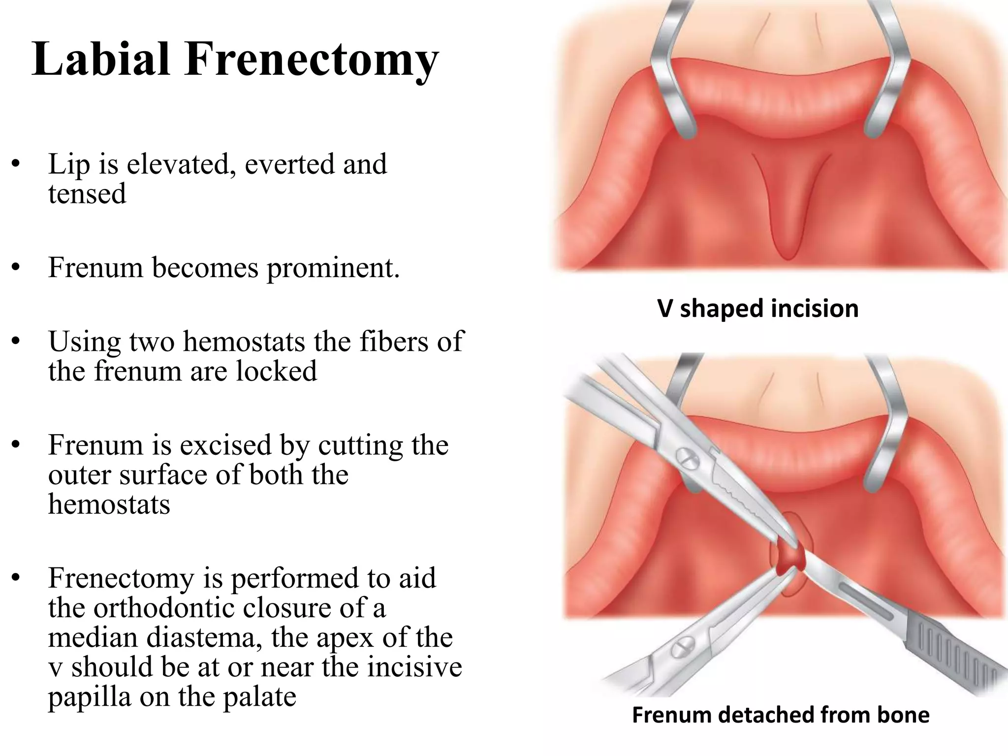 Soft tissue changes in preprosthetic surgery | PPTX