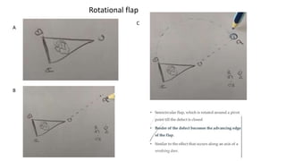 Rotational flap
A
B
C
 