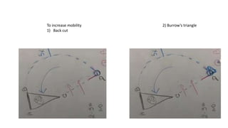 To increase mobility
1) Back cut
2) Burrow’s triangle
 