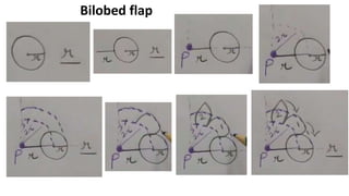 Bilobed flap
 