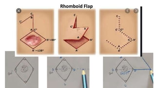 Rhomboid Flap
 