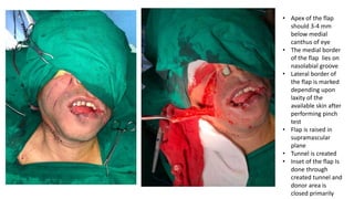 • Apex of the flap
should 3-4 mm
below medial
canthus of eye
• The medial border
of the flap lies on
nasolabial groove
• Lateral border of
the flap is marked
depending upon
laxity of the
available skin after
performing pinch
test
• Flap is raised in
supramascular
plane
• Tunnel is created
• Inset of the flap Is
done through
created tunnel and
donor area is
closed primarily
 