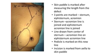 • Skin paddle is marked after
measuring the length from the
defect
• 3 points are marked – sternum,
xiphisternum, acromion
• Sternum –acromion line is
joined and xiphisternum
acromion line is joined
• Line drawn from center of
sternum – acromion line on
xiphisternum acromion line
• Pedicle is marked on this new
line
• Incision is marked from axilla to
skin paddle
 