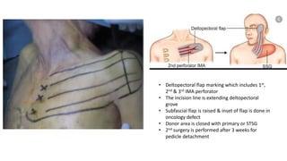 • Deltopectoral flap marking which includes 1st,
2nd & 3rd IMA perforator
• The incision line is extending deltopectoral
grove
• Subfascial flap is raised & inset of flap is done in
oncology defect
• Donor area is closed with primary or STSG
• 2nd surgery is performed after 3 weeks for
pedicle detachment
 