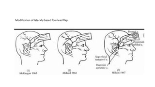 Modification of laterally based forehead flap
 