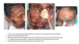 • In this case, laterally based forehead flap was used for reconstruction of lower lip defect
• Donor area was closed with STSG
• Vertical extension of the incision of the base of the flap was done to increase the flap reach
• 2nd surgery was performed after 3 weeks for detachment of the peduncle of the flap
• This flap can be used for intraoral defects by creating tunnel.
 