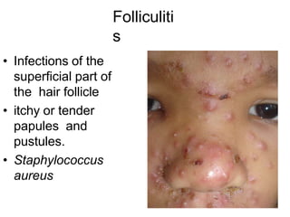 Folliculiti
s
• Infections of the
superficial part of
the hair follicle
• itchy or tender
papules and
pustules.
• Staphylococcus
aureus
 
