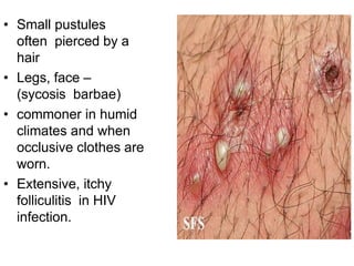 • Small pustules
often pierced by a
hair
• Legs, face –
(sycosis barbae)
• commoner in humid
climates and when
occlusive clothes are
worn.
• Extensive, itchy
folliculitis in HIV
infection.
 