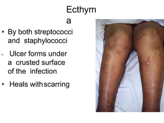 Ecthym
a
• By both streptococci
and staphylococci
• Ulcer forms under
a crusted surface
of the infection
• Heals withscarring
 