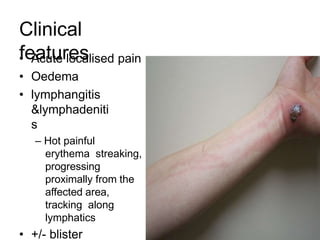 Clinical
features
• Acute localised pain
• Oedema
• lymphangitis
&lymphadeniti
s
– Hot painful
erythema streaking,
progressing
proximally from the
affected area,
tracking along
lymphatics
• +/- blister
 