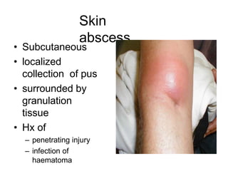 Skin
abscess
• Subcutaneous
• localized
collection of pus
• surrounded by
granulation
tissue
• Hx of
– penetrating injury
– infection of
haematoma
 