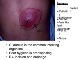 • S. aureus is the common infecting
organism
• Poor hygiene is predisposing
• Rx- incision and drainage
Features
:
Celluliti
s
Swollen
presen
t
Soft center
feels like
fluid
underneath
Painfu
l
T
ende
r
Celluliti
s
Absce
ss
 
