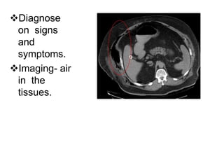 Diagnose
on signs
and
symptoms.
Imaging- air
in the
tissues.
 