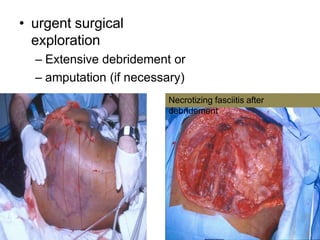 • urgent surgical
exploration
– Extensive debridement or
– amputation (if necessary)
Necrotizing fasciitis after
debridement
 