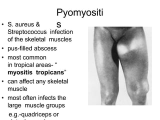 Pyomyositi
s
• S. aureus &
Streptococcus infection
of the skeletal muscles
• pus-filled abscess
• most common
in tropical areas- “
myositis tropicans”
• can affect any skeletal
muscle
• most often infects the
large muscle groups
e.g.-quadriceps or
 