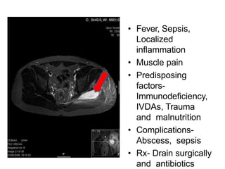 • Fever, Sepsis,
Localized
inflammation
• Muscle pain
• Predisposing
factors-
Immunodeficiency,
IVDAs, Trauma
and malnutrition
• Complications-
Abscess, sepsis
• Rx- Drain surgically
and antibiotics
 