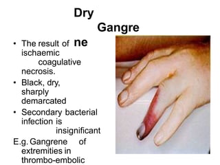 Dry
Gangre
ne
• The result of
ischaemic
coagulative
necrosis.
• Black, dry,
sharply
demarcated
• Secondary bacterial
infection is
insignificant
E.g. Gangrene of
extremities in
thrombo-embolic
 