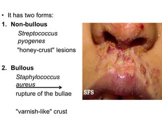 • It has two forms:
1. Non-bullous
Streptococcus
pyogenes
"honey-crust" lesions
2. Bullous
Staphylococcus
aureus
rupture of the bullae
"varnish-like" crust
 