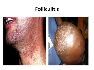 Folliculitis
 