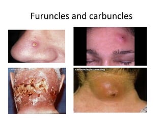 Furuncles and carbuncles
 
