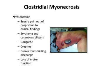 Clostridial Myonecrosis
•Presentation
– Severe pain out of
proportion to
clinical findings
– Erythema and
cutaneous blisters
– Gangrene
– Crepitus
– Brown foul smelling
discharge
– Loss of motor
function
 