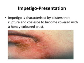 Impetigo-Presentation
• Impetigo is characterised by blisters that
rupture and coalesce to become covered with
a honey-coloured crust.
 