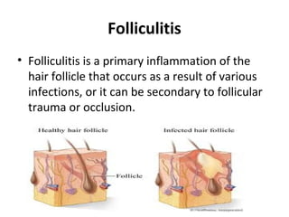 Folliculitis
• Folliculitis is a primary inflammation of the
hair follicle that occurs as a result of various
infections, or it can be secondary to follicular
trauma or occlusion.
 