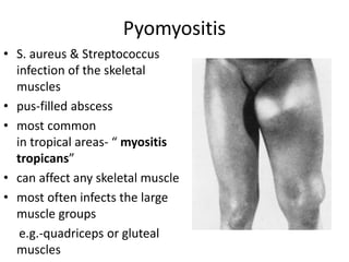 Muscular Abscess Skin and Soft tissue infections | PPTX