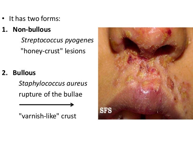 Skin and Soft tissue infections