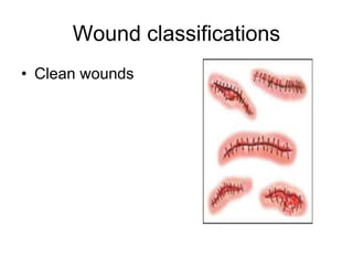 Wound classifications
• Clean wounds
 