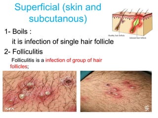 Superficial (skin and
subcutanous)
1- Boils :
it is infection of single hair follicle
2- Folliculitis
Folliculitis is a infection of group of hair
follicles;
 