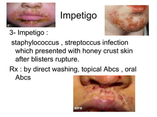 Impetigo
3- Impetigo :
staphylococcus , streptoccus infection
which presented with honey crust skin
after blisters rupture.
Rx : by direct washing, topical Abcs , oral
Abcs
 