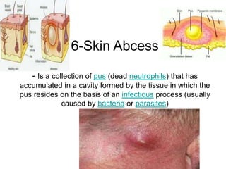6-Skin Abcess
- Is a collection of pus (dead neutrophils) that has
accumulated in a cavity formed by the tissue in which the
pus resides on the basis of an infectious process (usually
caused by bacteria or parasites)
 