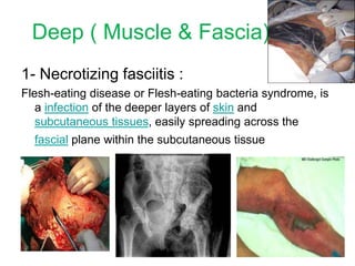 Deep ( Muscle & Fascia)
1- Necrotizing fasciitis :
Flesh-eating disease or Flesh-eating bacteria syndrome, is
a infection of the deeper layers of skin and
subcutaneous tissues, easily spreading across the
fascial plane within the subcutaneous tissue
 