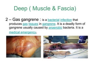 2 – Gas gangrene : is a bacterial infection that
produces gas tissues in gangrene. It is a deadly form of
gangrene usually caused by anaerobic bacteria. It is a
medical emergency.
Deep ( Muscle & Fascia)
 