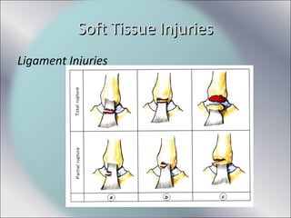 Ligament Injuries
Soft Tissue InjuriesSoft Tissue Injuries
 