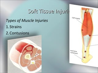 Types of Muscle Injuries
1.Strains
2.Contusions
Soft Tissue InjuriesSoft Tissue Injuries
 